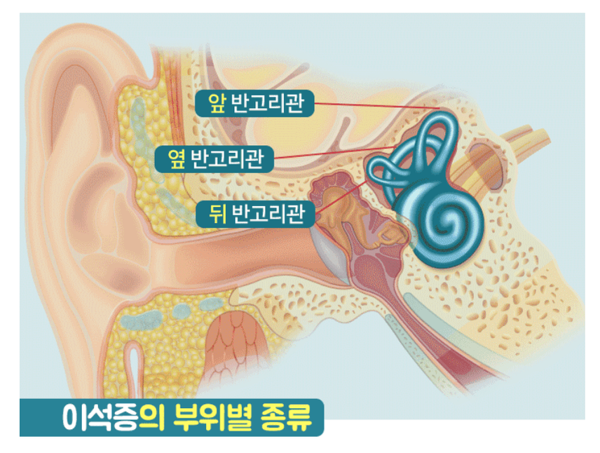이석증으로 힘든 시기를 보내고 지금도 가끔씩 재발하지만 그런데로 견딜만하네요