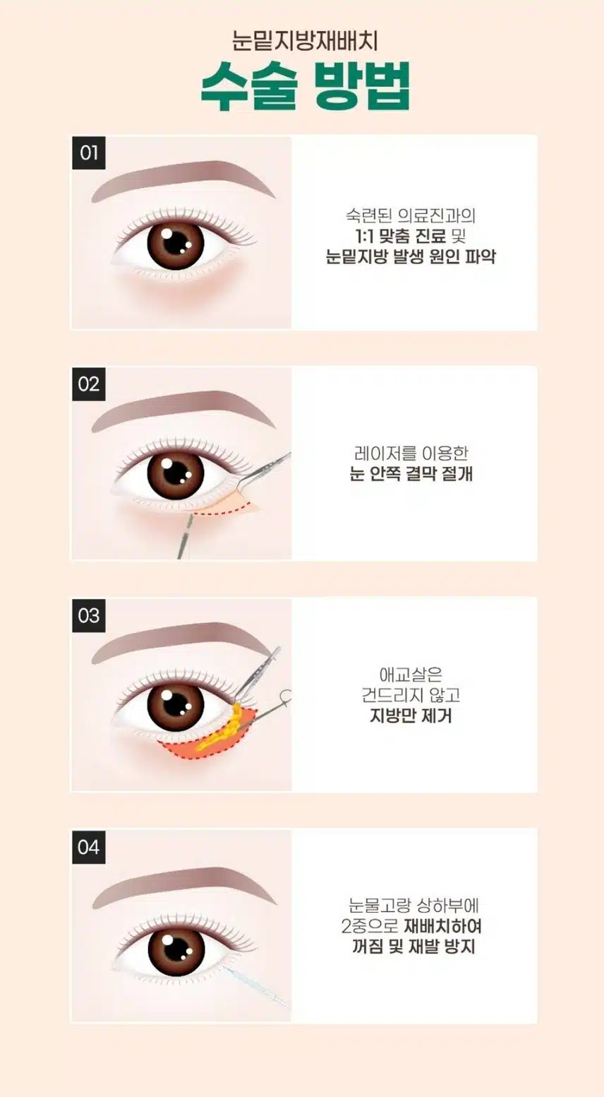 눈밑 지방재배치 수술 빋고싶어요