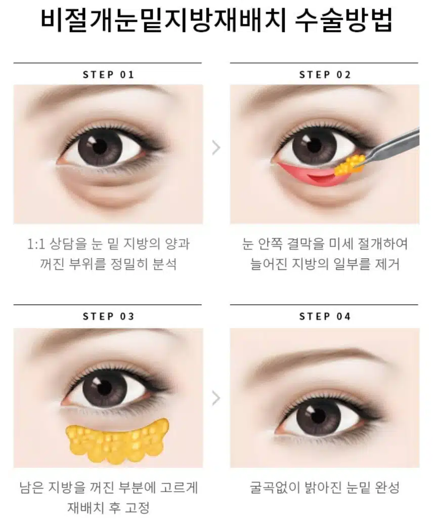 눈밑 지방재배치 수술 빋고싶어요