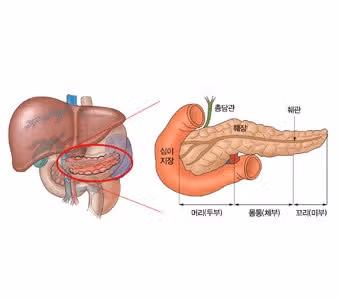 등쪽의 통증과 소화불량 증상으로 췌장암 검사 받은 후기.