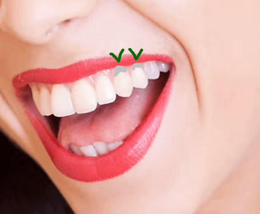 치아 아래쪽이 패여있는데 어떻게 관리할지 고민이에요