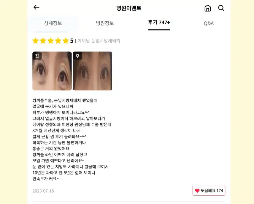 강남구 에이탑 눈밑지방재배치 후기
