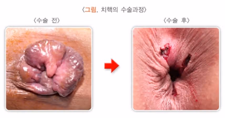치질을 겪은 후 건강한 생활습관을 유지하고 있는 제 이야기를 공유합니다 