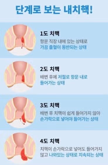 치질을 겪은 후 건강한 생활습관을 유지하고 있는 제 이야기를 공유합니다 