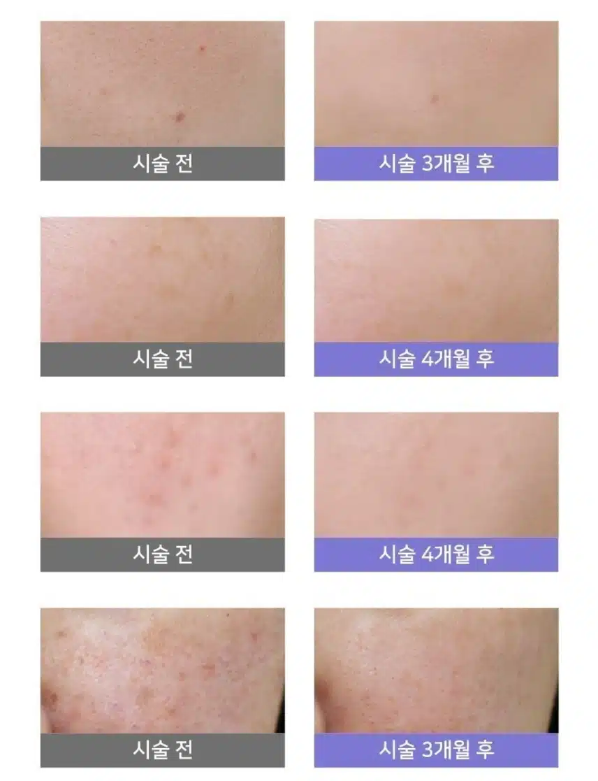 서초 피부색소 지우개 에이톤/토닝 9.9만원 후기
