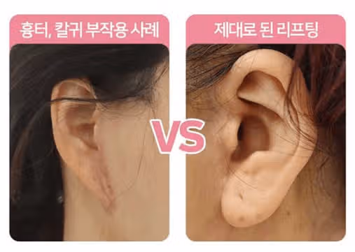 서울시 강남구 추가금❎♥미니거상 3종(거상+지흡) 후기