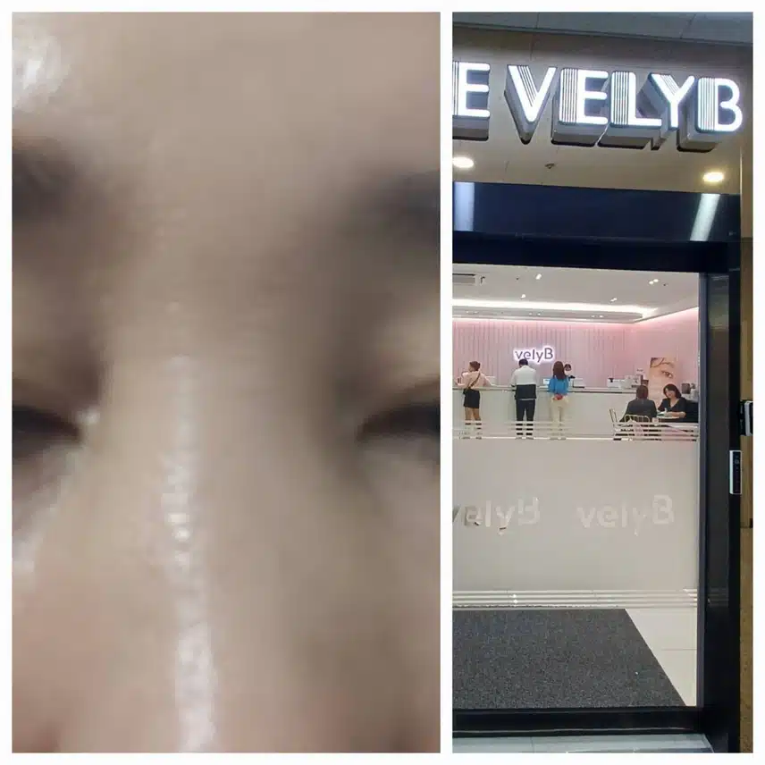 [탑리뷰어4기] 미간과 콧등 보톡스 후기~~~