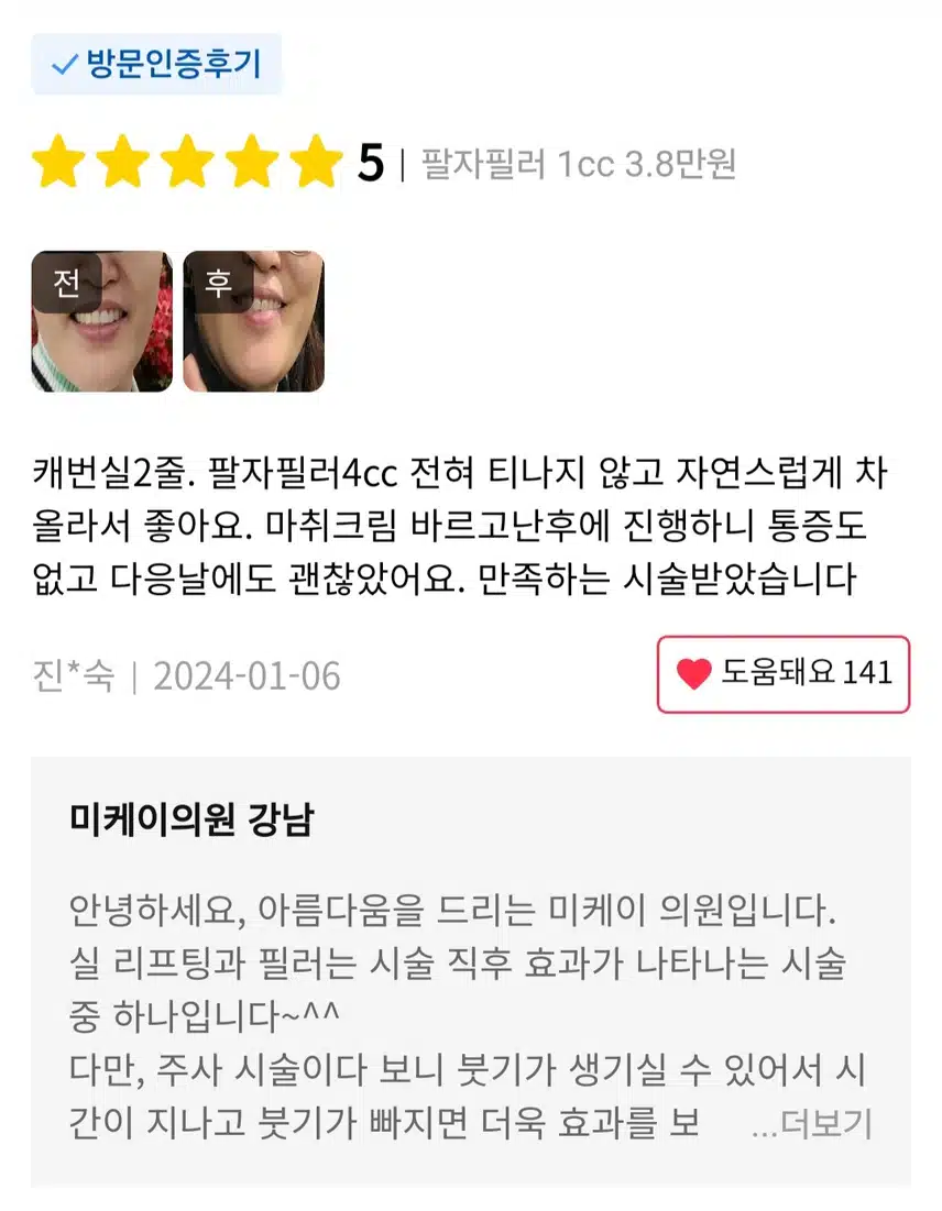 서초구 미케이의원 팔자 필러 1cc 3.8만원 후기