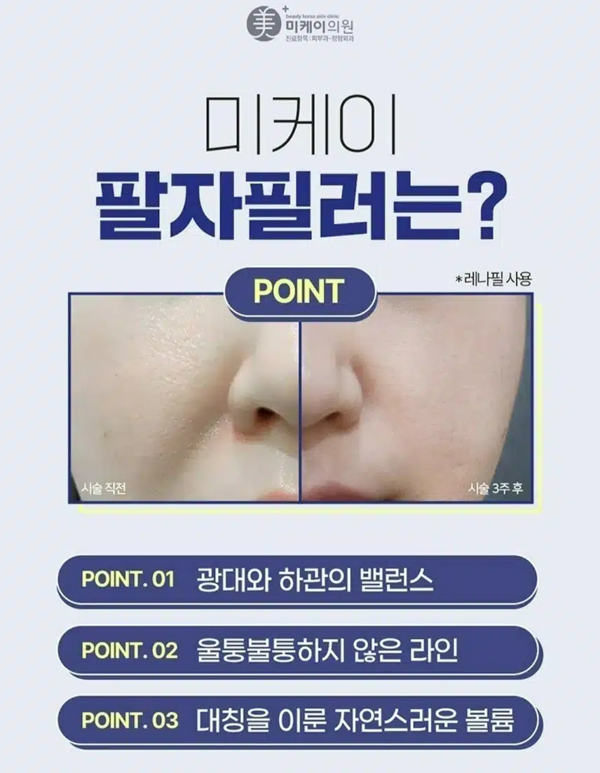 서초구 미케이의원 팔자 필러 1cc 3.8만원 후기