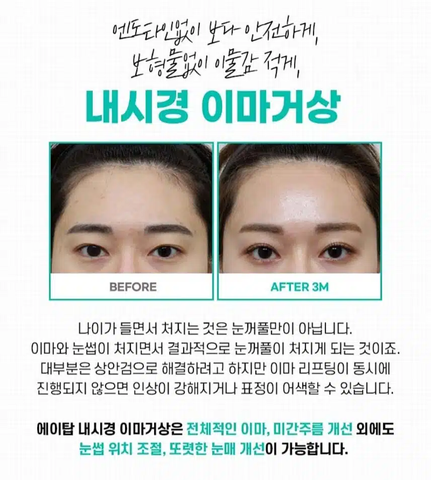 강남구 에이탑의원 내시경 이마거상 190만원 후기