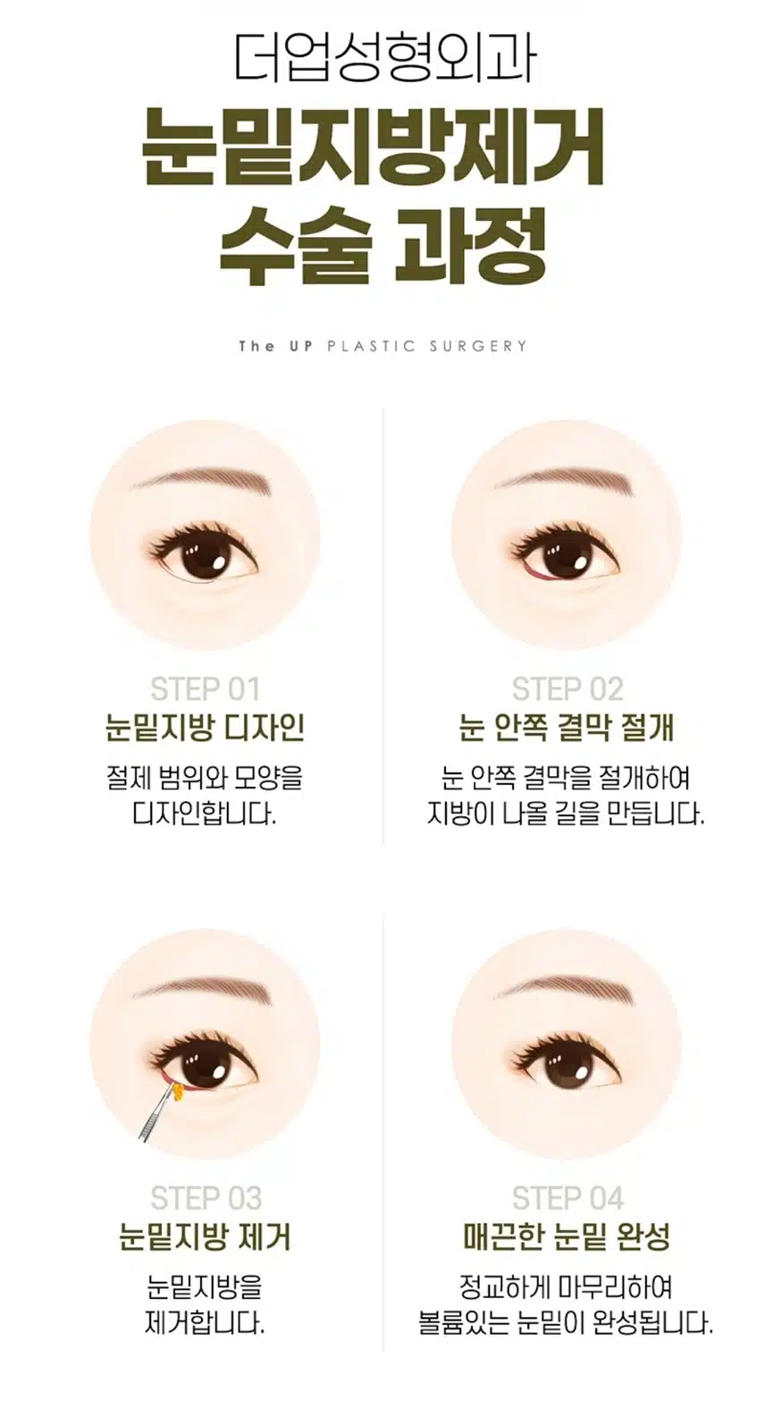 서초구 더업성형외과 눈밑지방제거39만원 후기공유해요