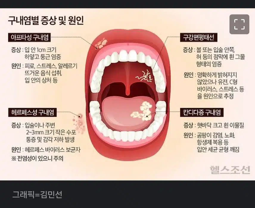 구내염 빨리 낫고픈데...집에 있는 가글 쓰면 도움이 될까??