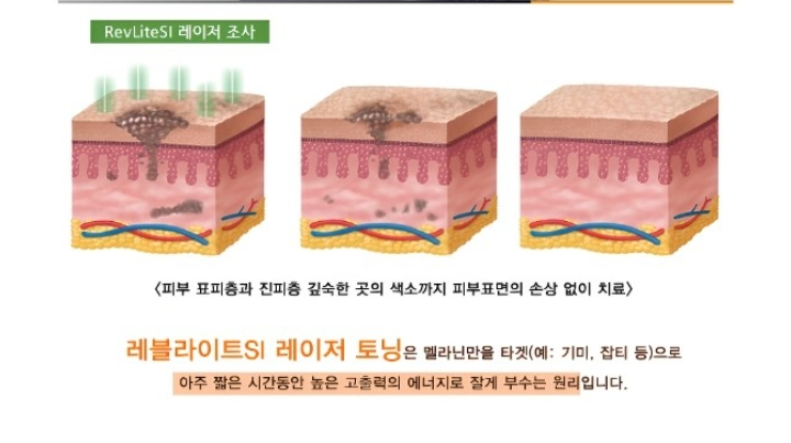 기미제거로 피코토닝 받아보고 싶어요