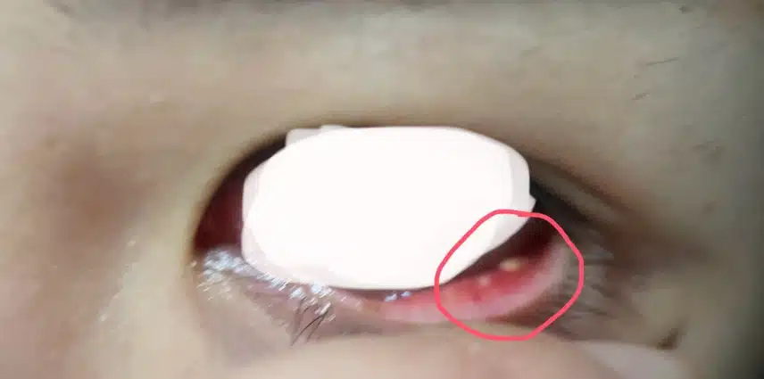 (징그러울수있음) 눈 안에 뭔가 났는데 이게 뭘까요?