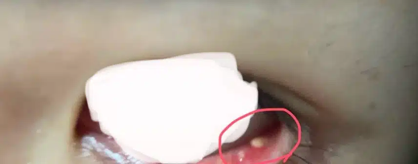 (징그러울수있음) 눈 안에 뭔가 났는데 이게 뭘까요?