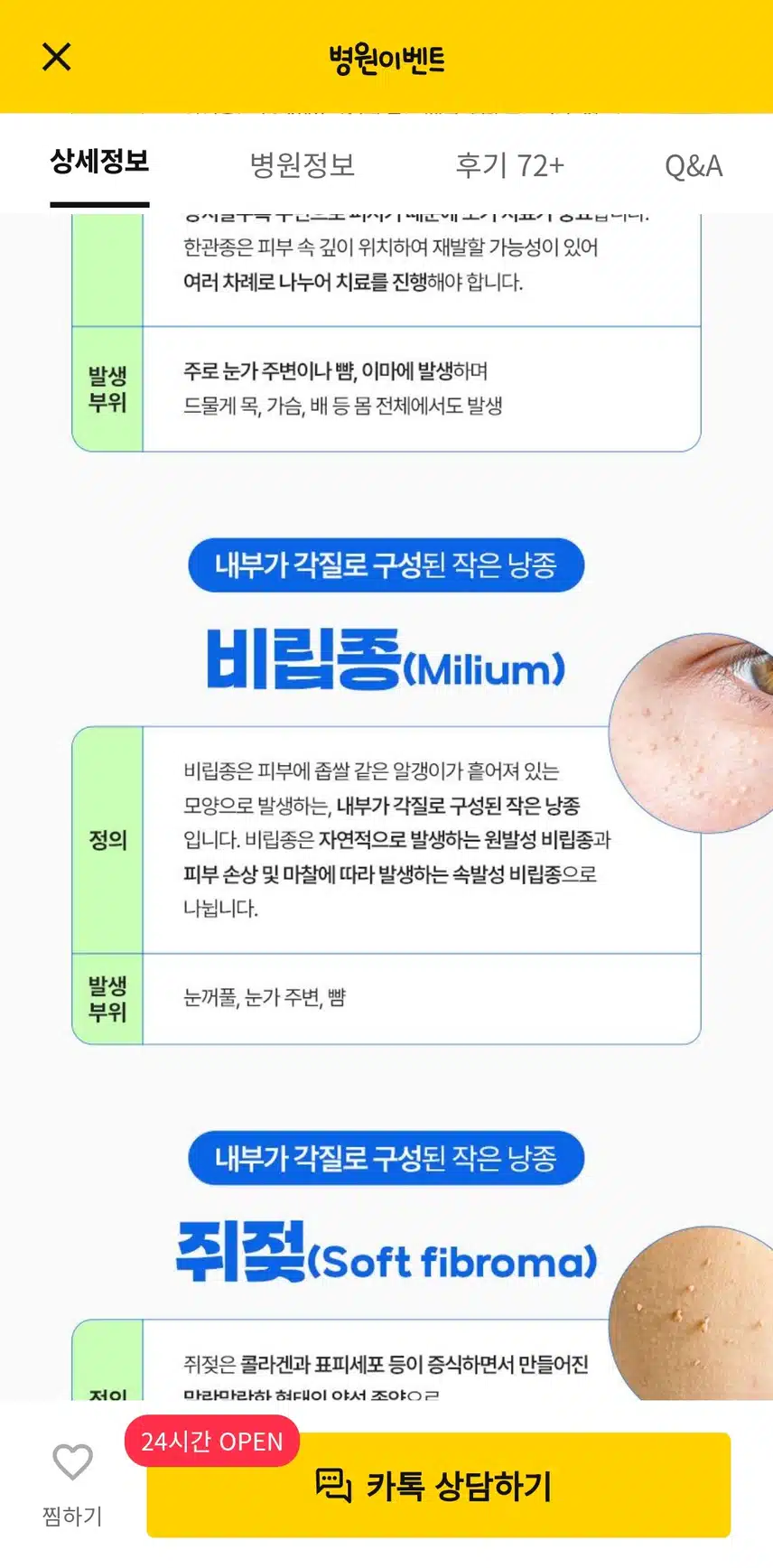서울 서초구의 한관종 비립종 쥐젖제거 후기