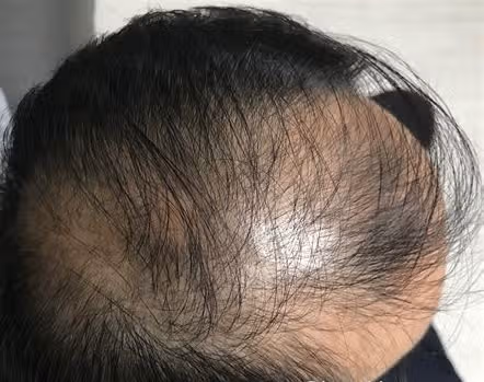 탈모 약 먹는 것을 얼마동안 중지 해도 괜찮은것일까요?