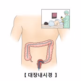 대장암 예방을 위해 대장내시경 검사 받은 후기