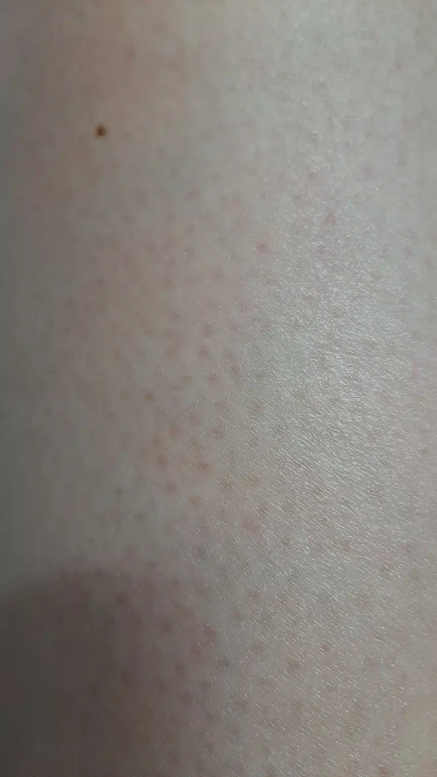 모공각화증 어떻게 하면 없앨수 있을까요? 