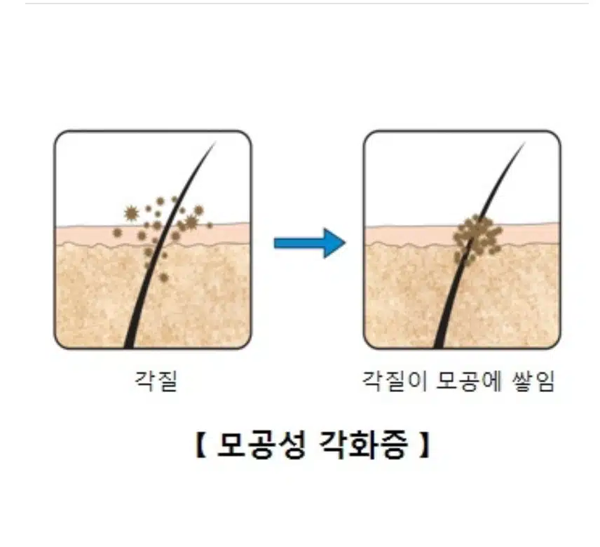 모공각화증 어떻게 하면 없앨수 있을까요? 
