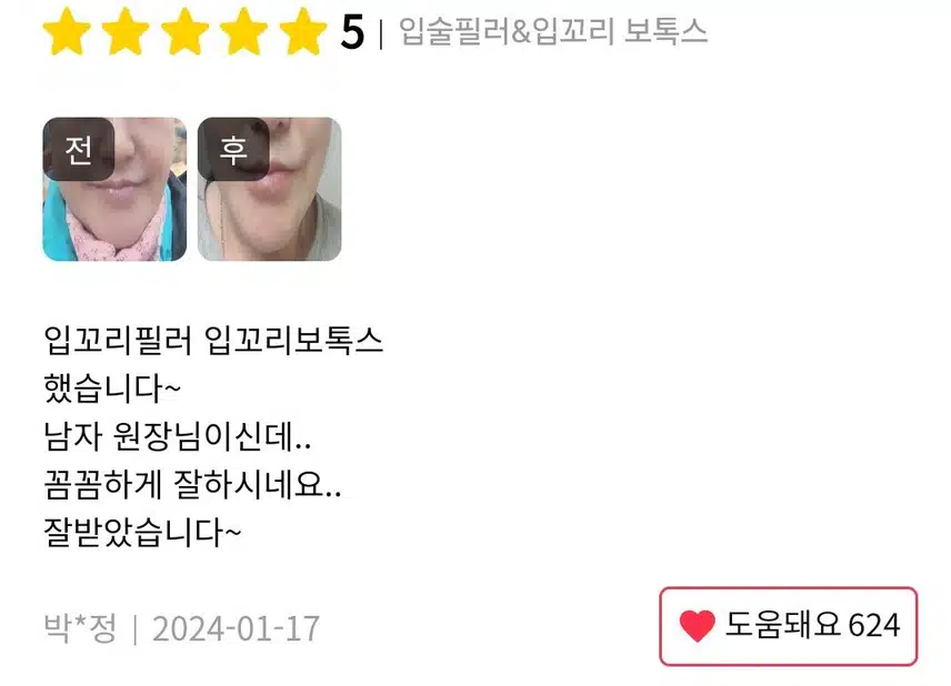 서초구 미케이의원 입꼬리보톡스 4만9천원 후기 추천해요