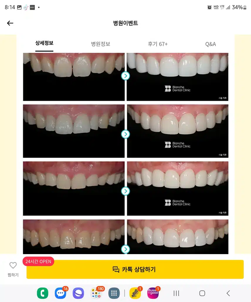 서초구 블랑쉬치과 블랑쉬라미네이트(45만원) 후기 추천