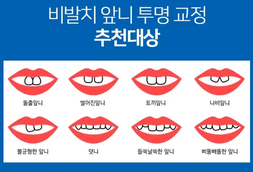 강남구 특가 앞니 투명 (부분) 교정 70만원 후기