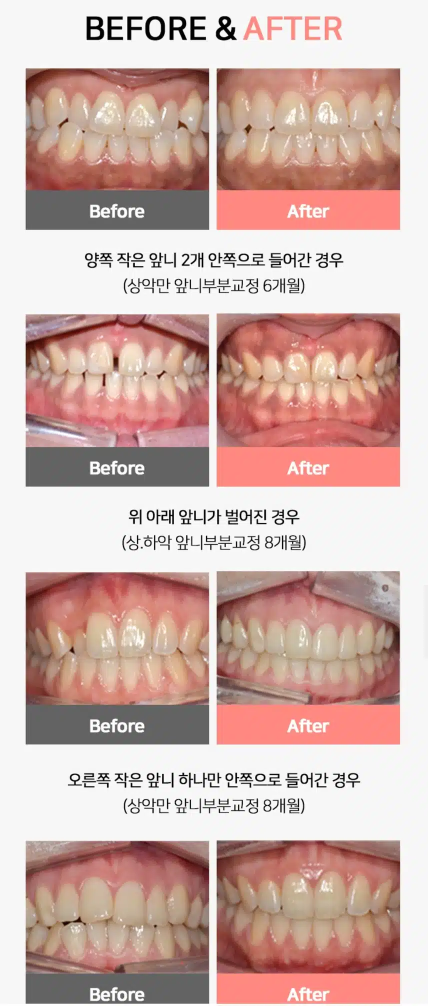 강남구 특가 앞니 투명 (부분) 교정 70만원 후기