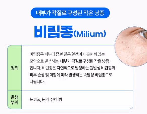 서울 서초구 플래너❤비립종,쥐젖 제거 후기 추천