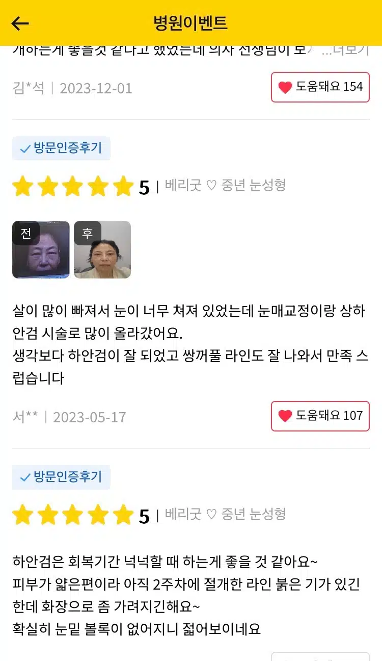 서초구 베리굿 ♡ 중년 눈성형 후기 추천합니다 
