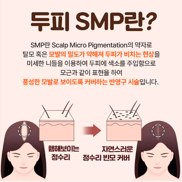 서울 서초구 미케이 두피SMP 헤어라인반영구 후기 추천