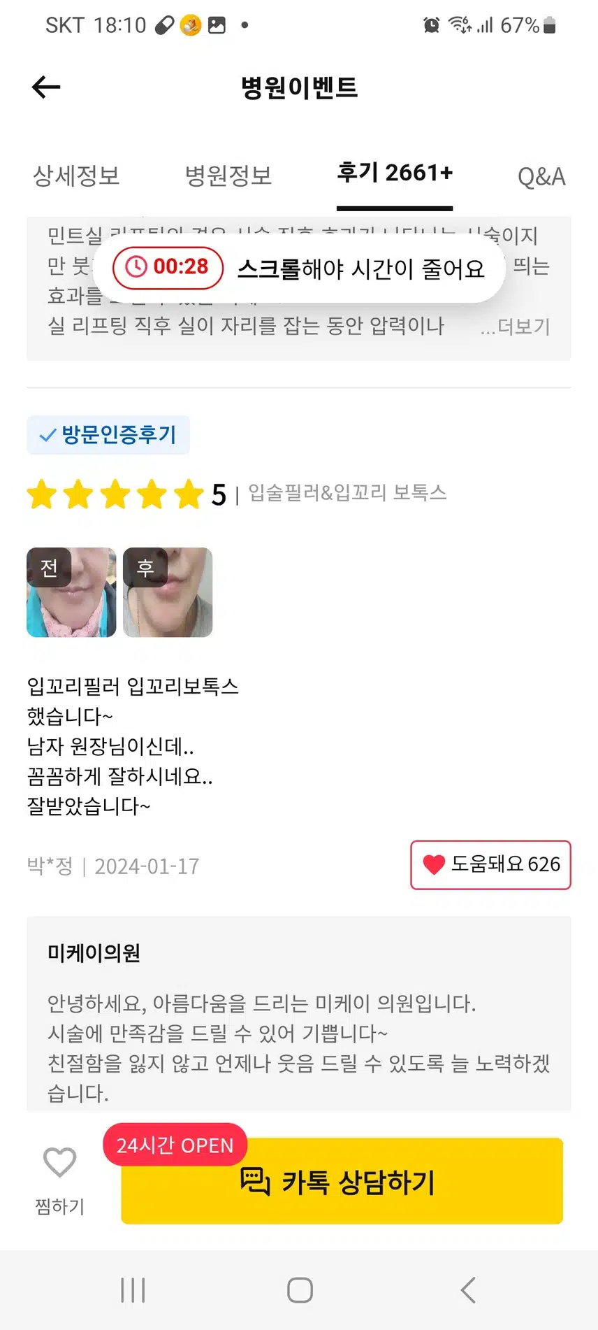 서초구 미케이의원의 입꼬리보톡스 4만9천원의 후기 추천합니다.
