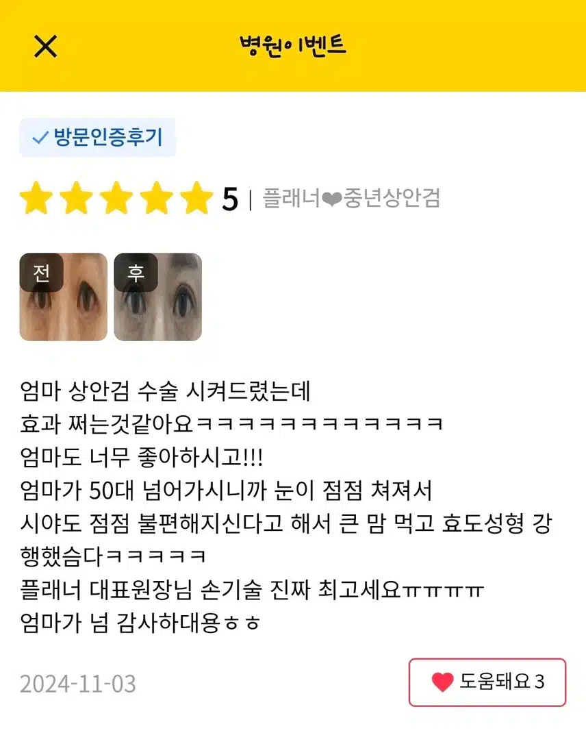 서초 플래너성형외과의원 중년상안검 60만원 후기 도움 많이 돼요