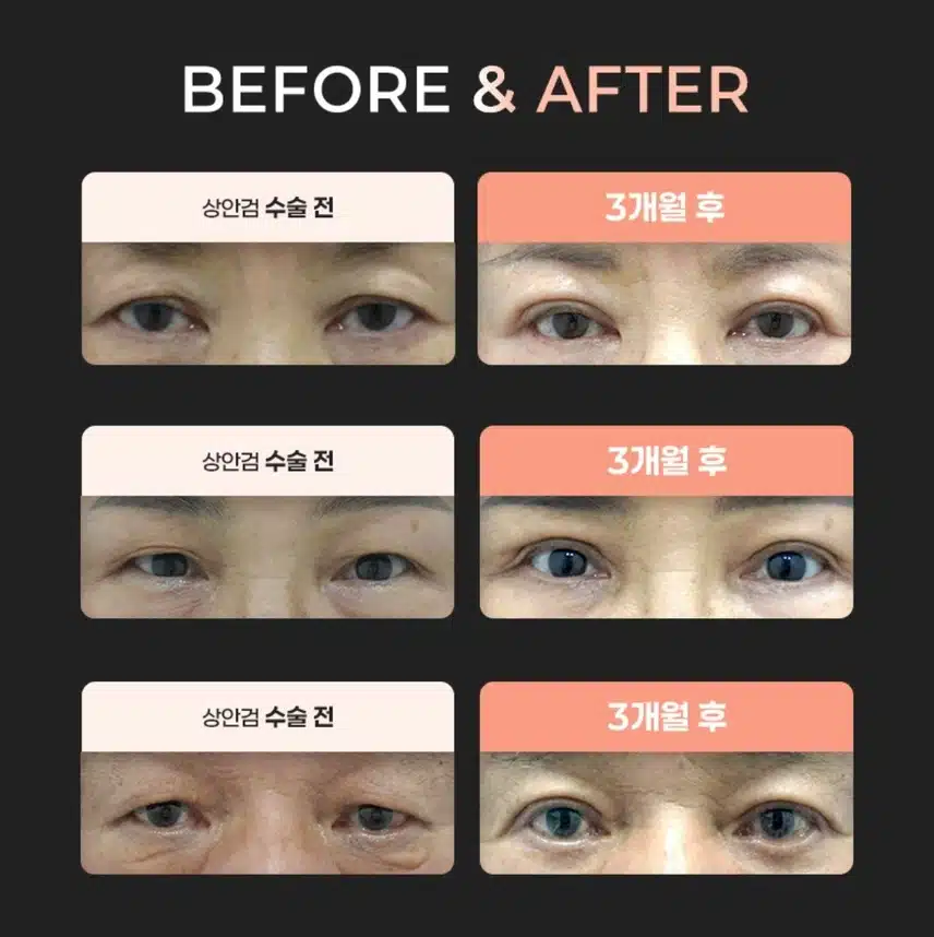 서초 플래너성형외과의원 중년상안검 60만원 후기 도움 많이 돼요