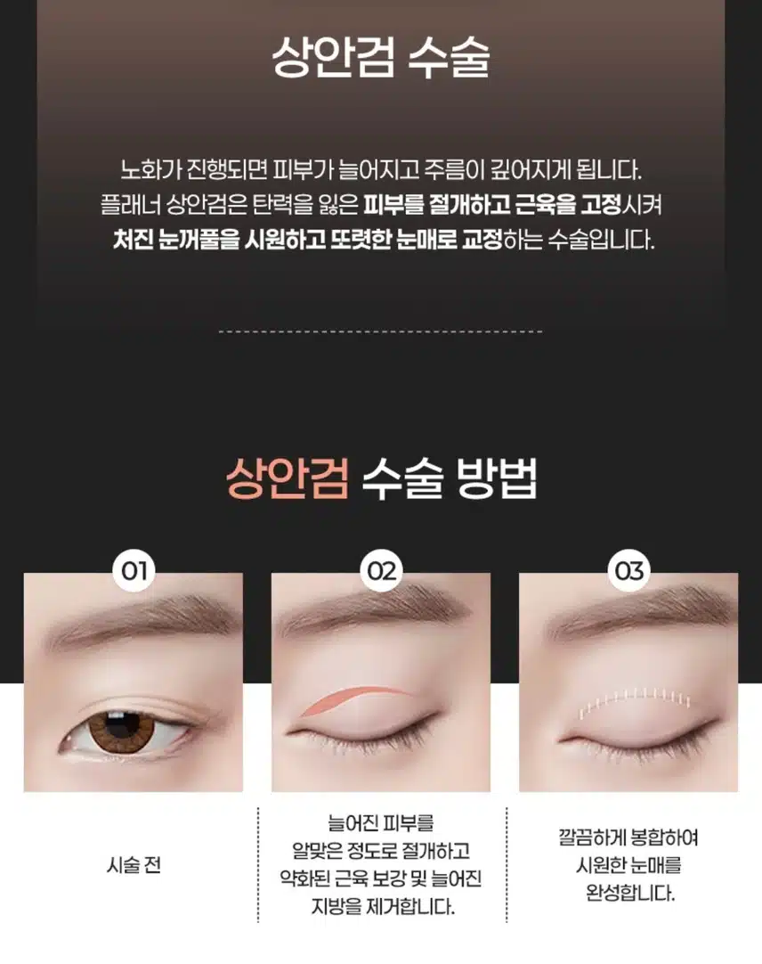 서초 플래너성형외과의원 중년상안검 60만원 후기 도움 많이 돼요