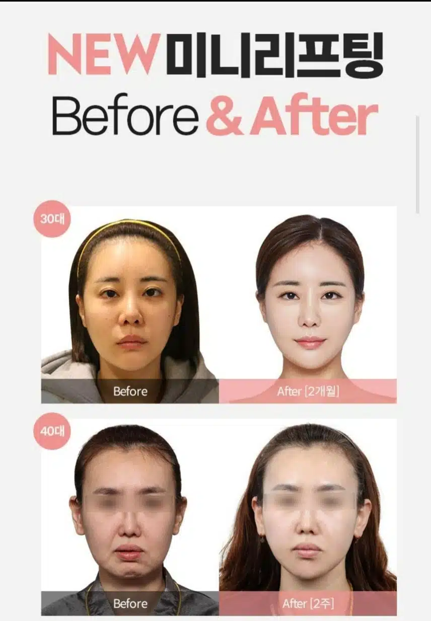 리팅성형외과 미니리프팅 후기 도움되요