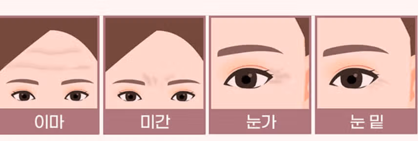 서초구 미케이의원 주름보톡스 후기