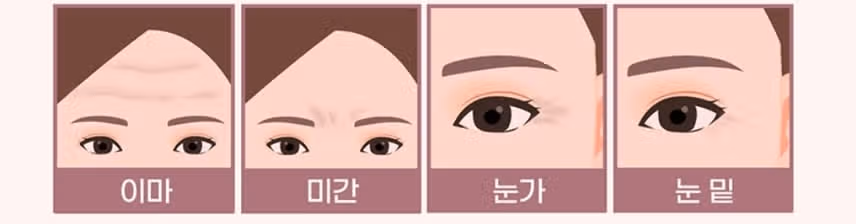 서초 미케이의원/ 주름 보톡스 2.5만원 /후기 추천합니다 