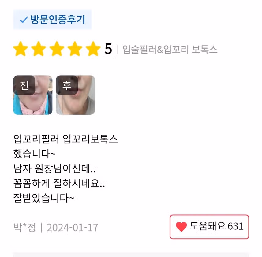 서초 미케이의원/ 주름 보톡스 2.5만원 /후기 추천합니다 