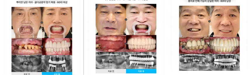 서울 서초구 하루플란트치과 임플란트 개당 29만원 /전체290만원  후기 추천합니다