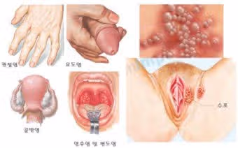 성 접촉을 통해 전파되는 성병 임질 마음도 몸도 상처받았었던 후기 공유합니다 