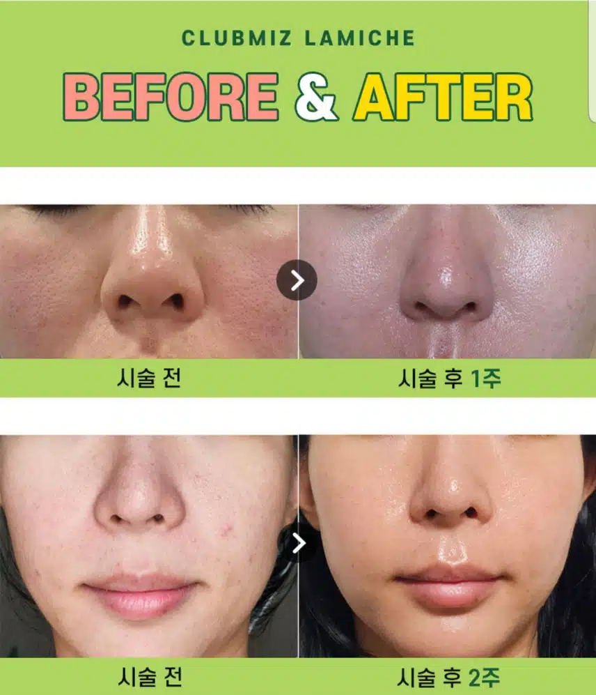 송파구 코모공 or 양볼 포인트레이저 5만원 후기 추천