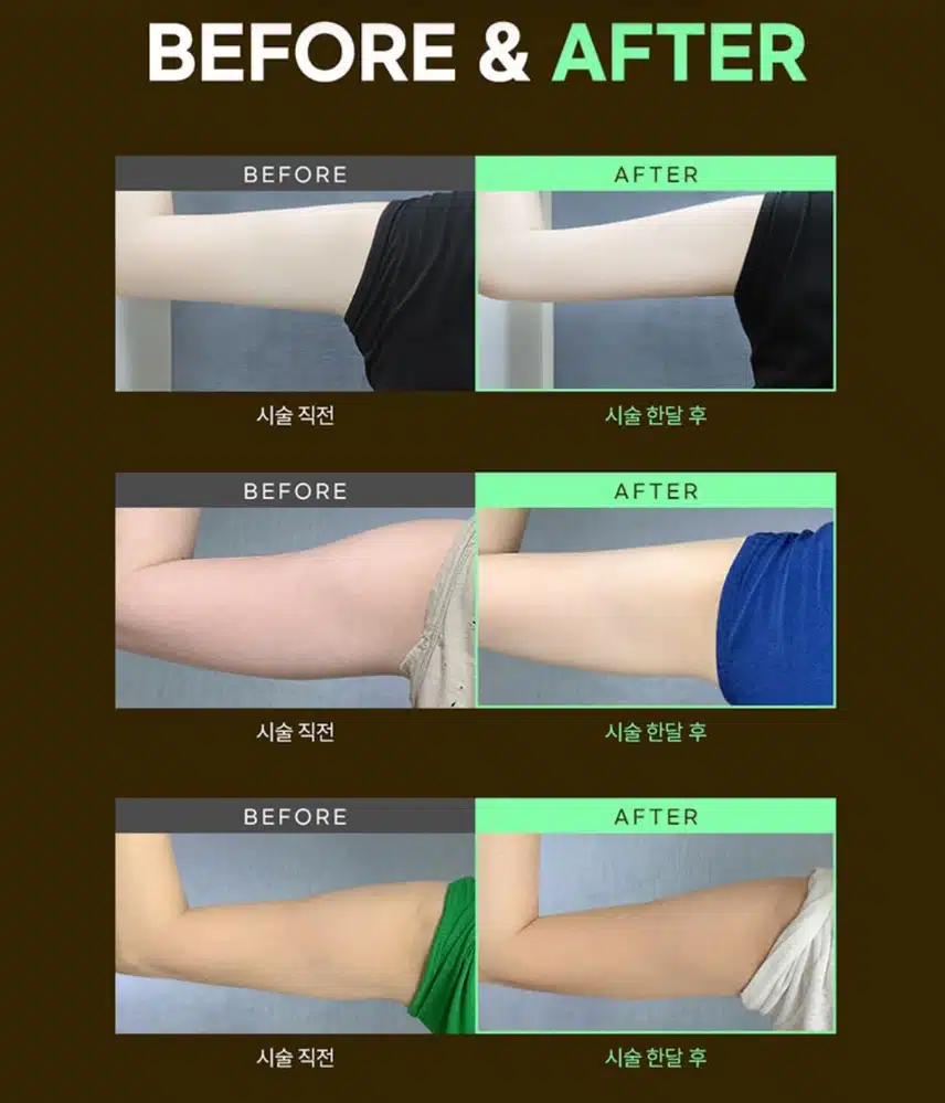 서초구 미케이 의원 slim fit 팔뚝빼기 추천❤️ 및 후기