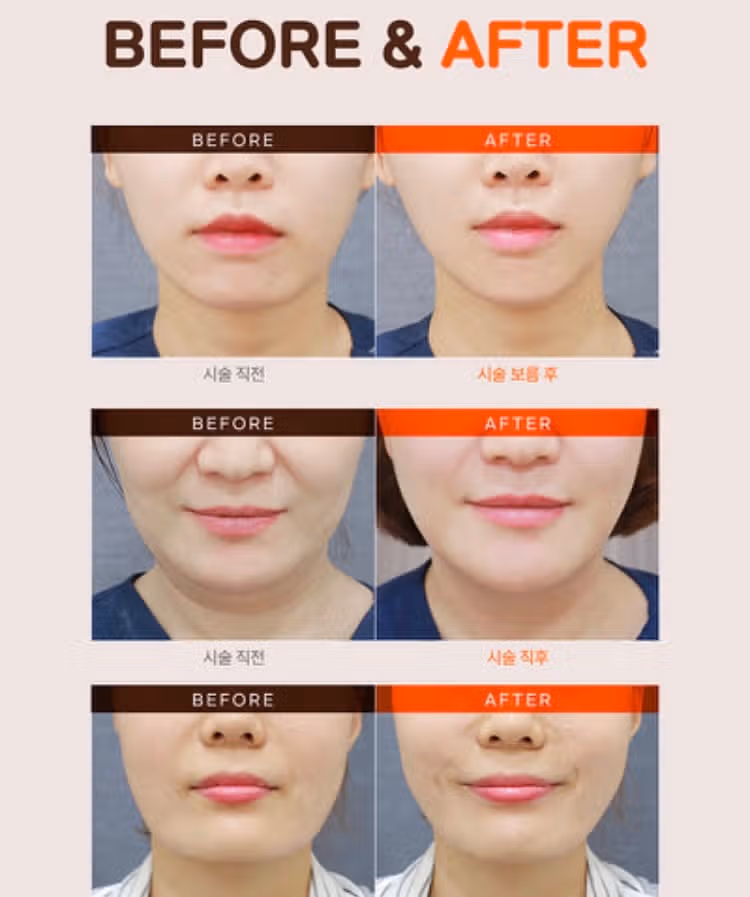 미케이 서초 슈링크400샷 윤곽톡스 후기 추천해요👍