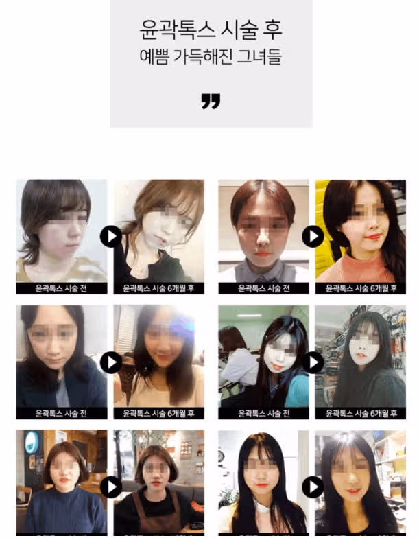경기도 수원시 권선구 갸름한 V라인 윤곽톡스 후기