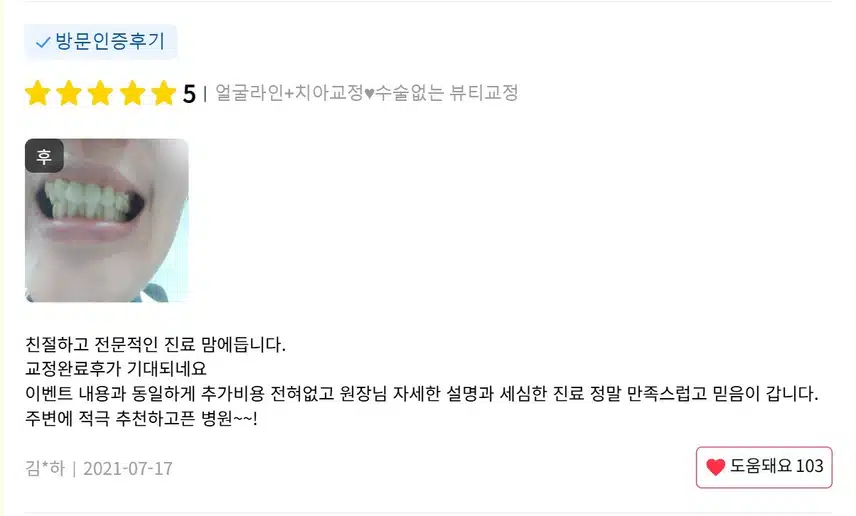 강남구 얼굴라인+치아교정♥수술없는 뷰티교정 후기 추천해요.