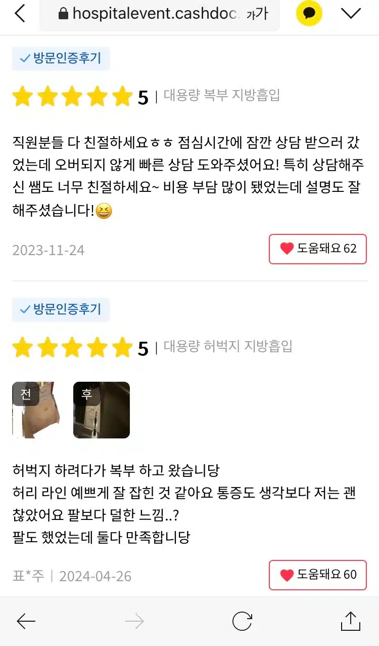 강남구 대용량 복부 지방흡입 후기 추천합니다 