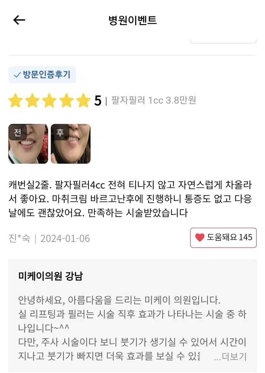 서초 미케이의원 팔자필러 1cc 3.8만원 후기 추천