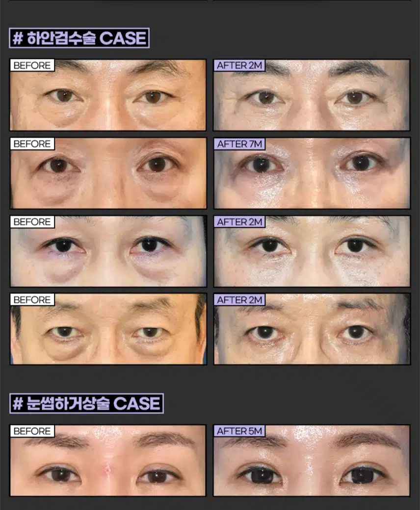 강남구 탑페이스 중년 눈성형 눈썹하거상술 후기 추천합니다.