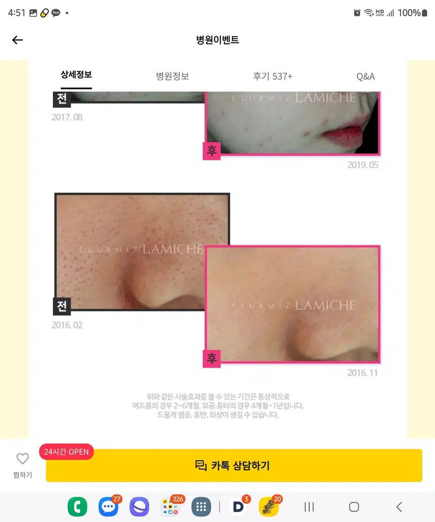 송파구 클럽미즈라미체의원(4차원피부측정, 피부레이저, 부분 집중레이저 27만원)후기 후기 추천